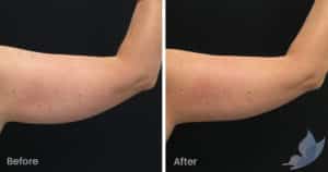 Coolsculpting spot fat reduction