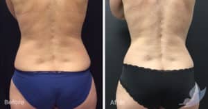 Coolsculpting spot fat reduction