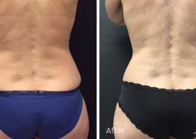 Coolsculpting spot fat reduction