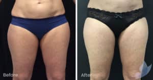 Coolsculpting spot fat reduction