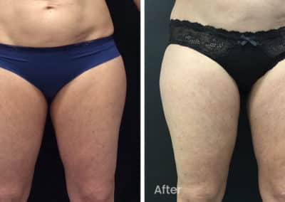 Coolsculpting spot fat reduction