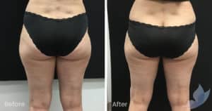 Coolsculpting spot fat reduction