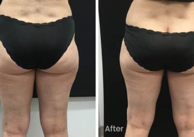 Coolsculpting spot fat reduction