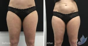 Coolsculpting spot fat reduction