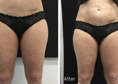 Coolsculpting spot fat reduction