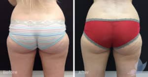 Coolsculpting spot fat reduction