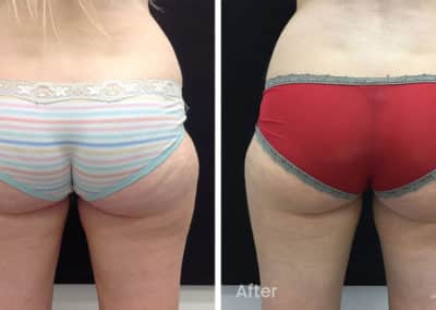 Coolsculpting spot fat reduction