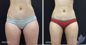 Coolsculpting spot fat reduction