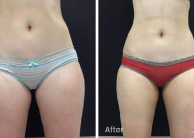 Coolsculpting spot fat reduction