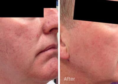 Veins and Pigmentation Before and After Gallery