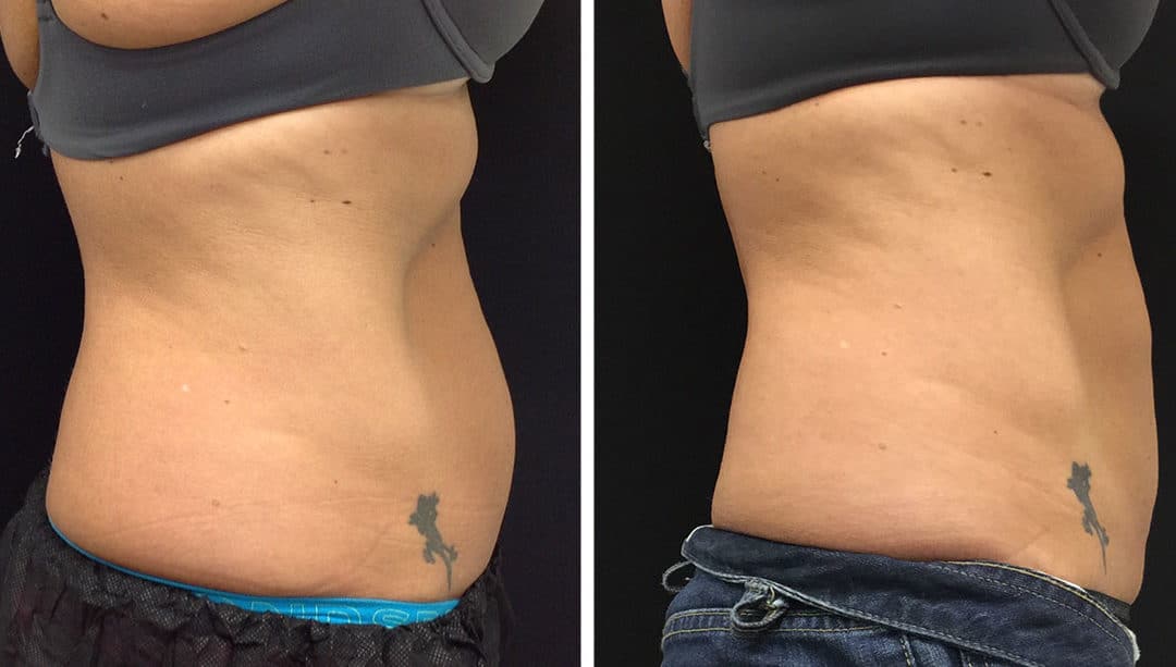 Fat Reduction Before and After Gallery