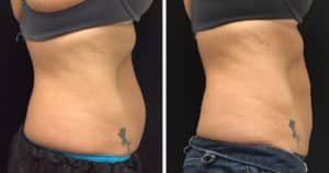 Fat reduction with Coolsculpting - FS tummy side view