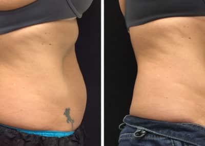 Fat reduction with Coolsculpting - FS tummy side view