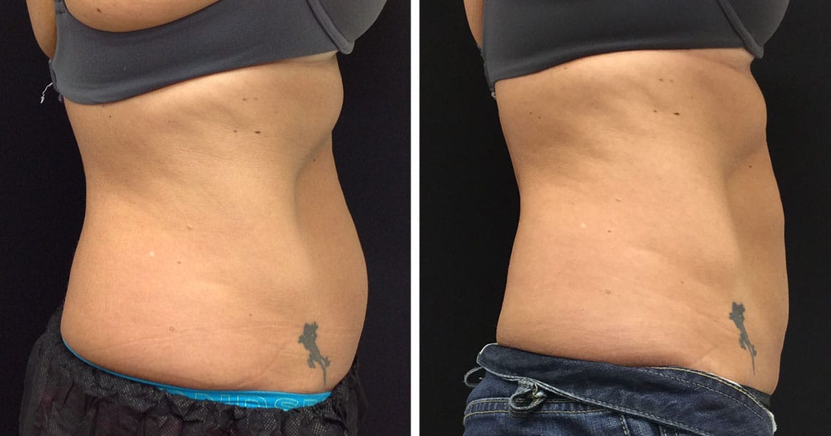 Fat Reduction Before and After Gallery