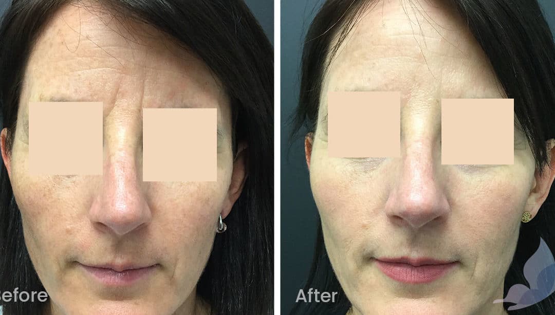 Fine Lines and Wrinkles Before and After Gallery