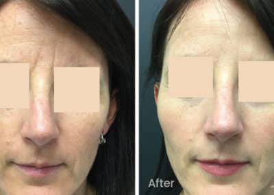 Fine Lines and Wrinkles Before and After Gallery