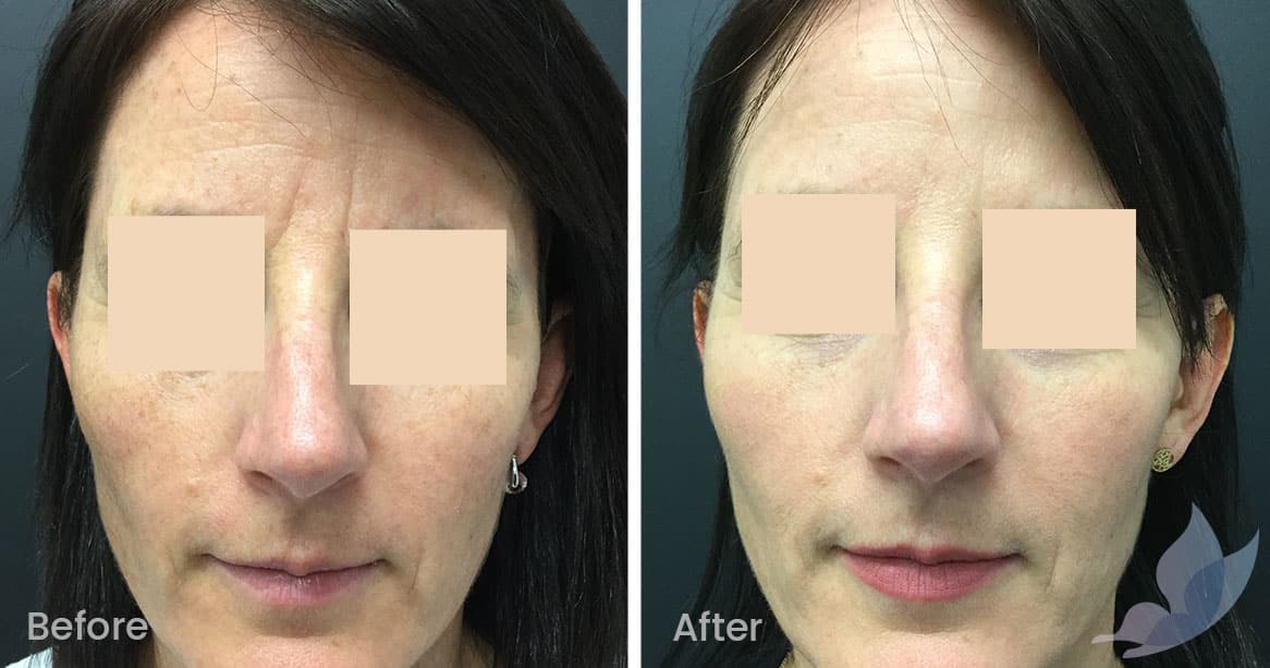 Fine Lines and Wrinkles Before and After Gallery