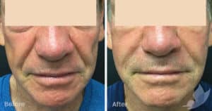 Fine Lines and Wrinkles - Nasolabial Folds