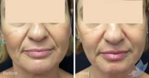 Fine Lines and Wrinkles - Nasolabial Folds