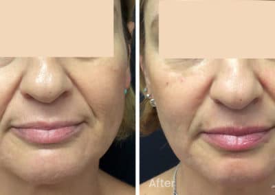 Fine Lines and Wrinkles - Nasolabial Folds