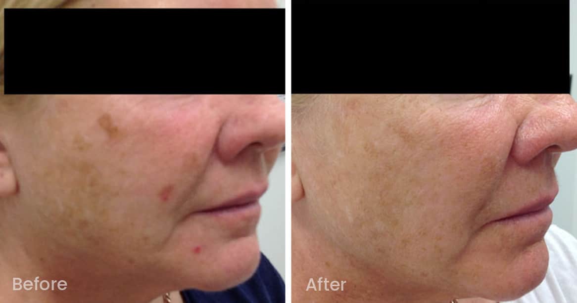 SkinPen microneedling before and after images