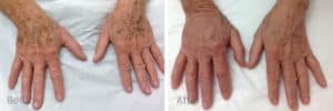 Pigmentation before and after image, hands