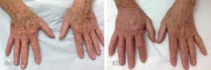 Pigmentation before and after image, hands