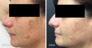 Facial pigmentation