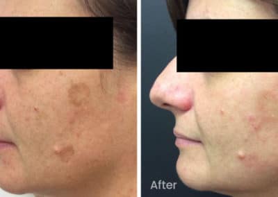 Freckles, Age Spots and Sun Damage Before and After Gallery