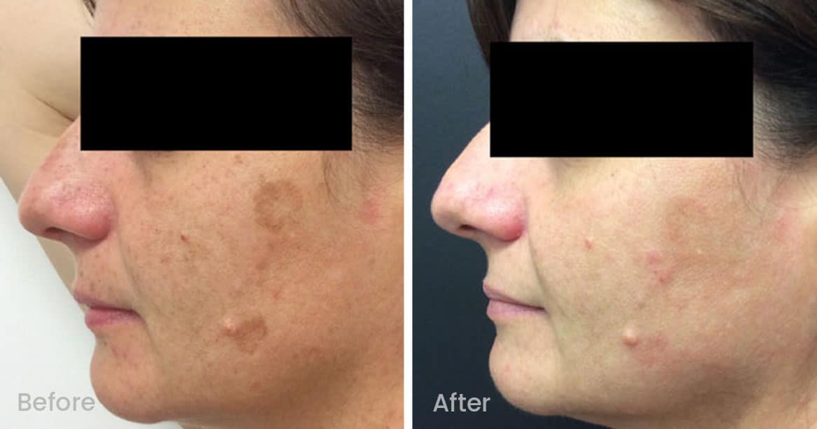 Freckles, Age Spots and Sun Damage Before and After Gallery