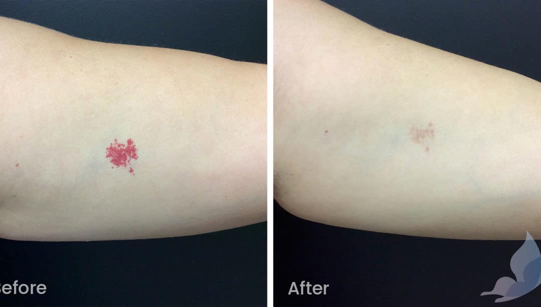 Birthmarks and Capillaries Before and After Gallery
