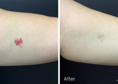 Birthmarks and Capillaries Before and After Gallery