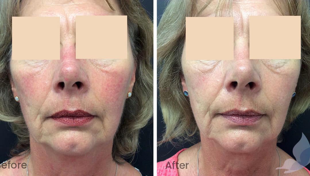 Redness and Rosacea Before and After Gallery