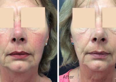 Redness and Rosacea Before and After Gallery