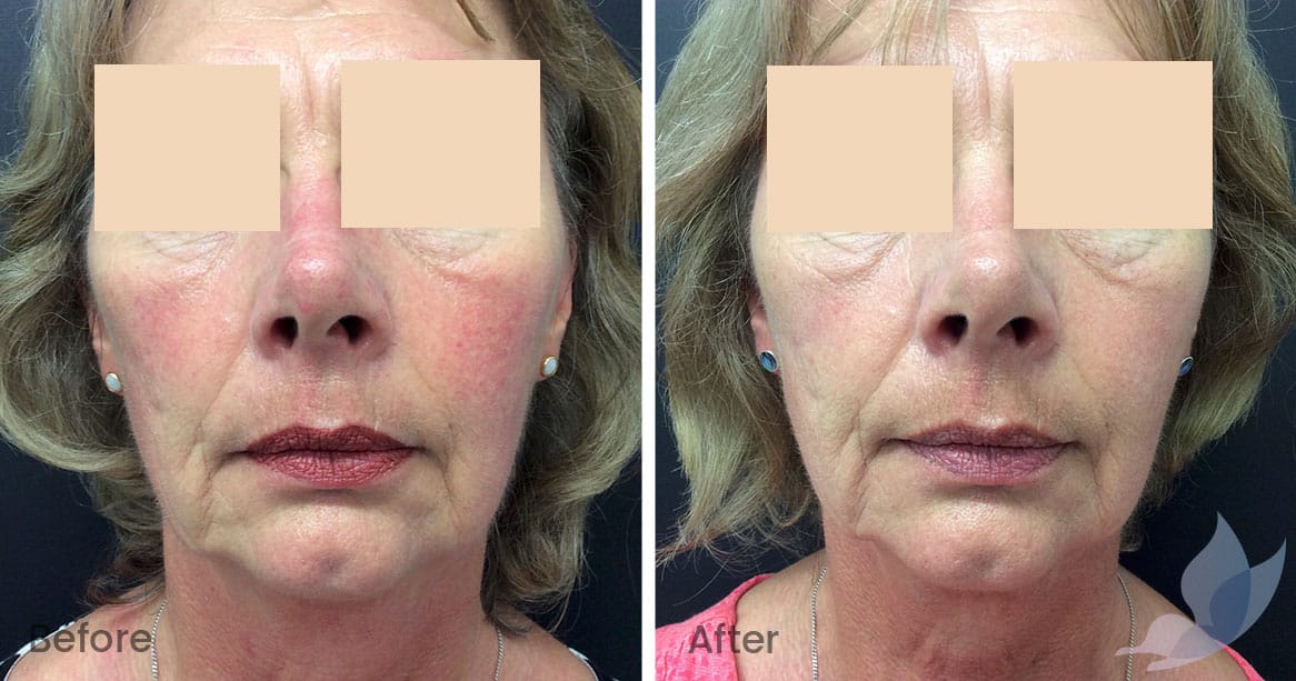 Redness and Rosacea Before and After Gallery