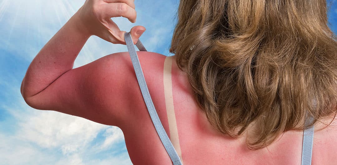 What Is Your Sunburn Trying to Tell You