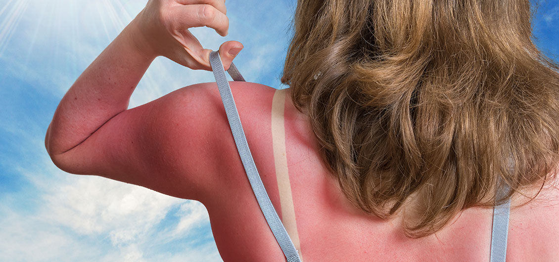 What Is Your Sunburn Trying to Tell You