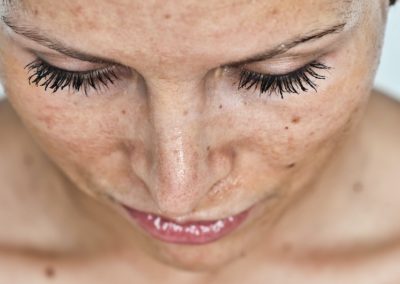 Spoiler Alert: Sunburn Might Spoil Your Treatment