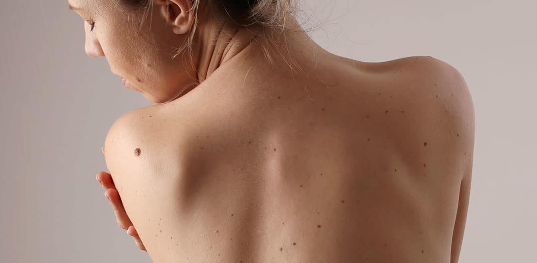 Do you know how to check your own skin?