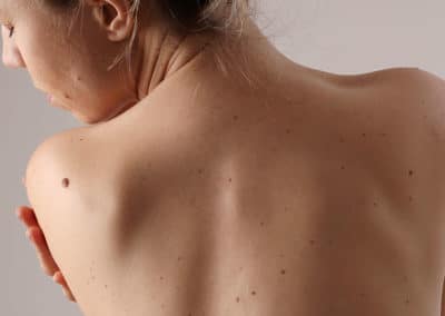 Do you know how to check your own skin?