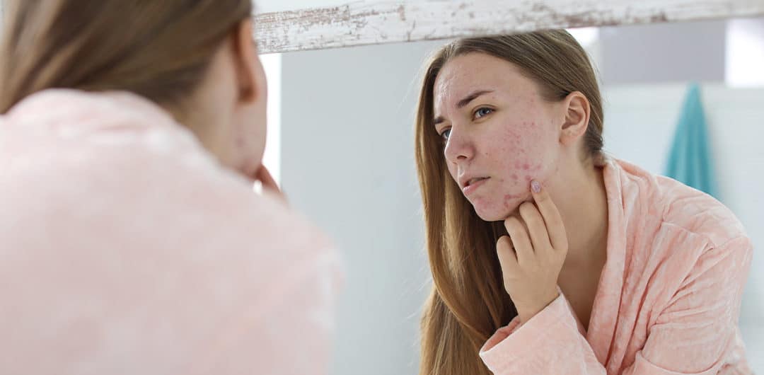 Recurring Nightmare: Why Facial Acne Keeps Coming Back