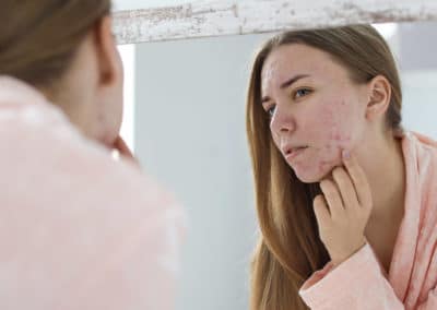 Recurring Nightmare: Why Facial Acne Keeps Coming Back