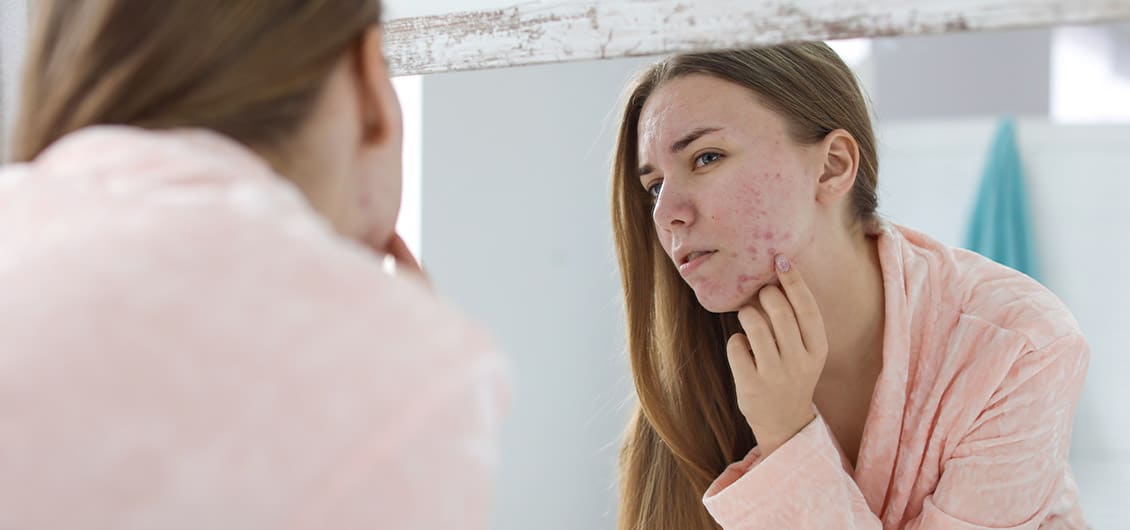 young woman looking in the mirror at acne on her face