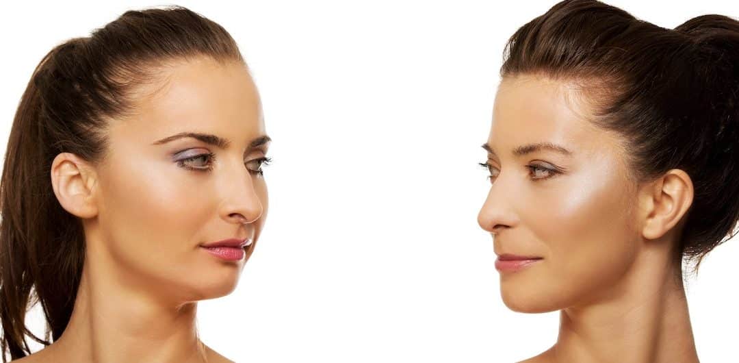 Face Off: Vivace RF Treatment versus Hydrafacial