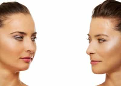 Face Off: Vivace RF Treatment versus Hydrafacial