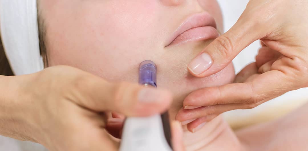 Why Everyone Loves SkinPen