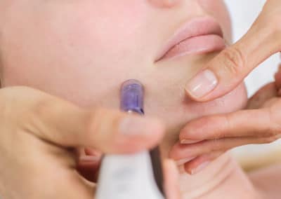 Why Everyone Loves SkinPen