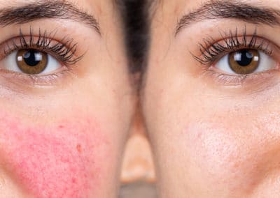Types of Rosacea & Helpful Treatments