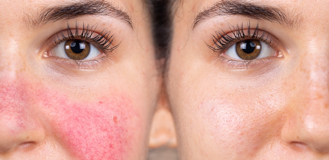 Types of Rosacea & Helpful Treatments