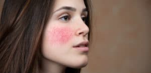 how to know if its redness or rosacea